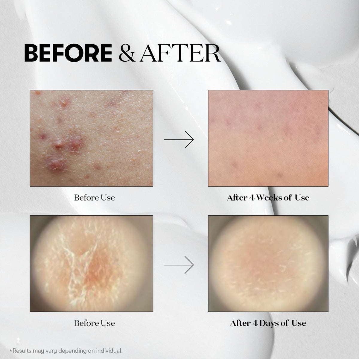 VT Cosmetics 100 Reedle Shot 10ea - official product image 5